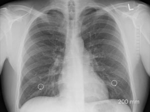 x-ray of chest